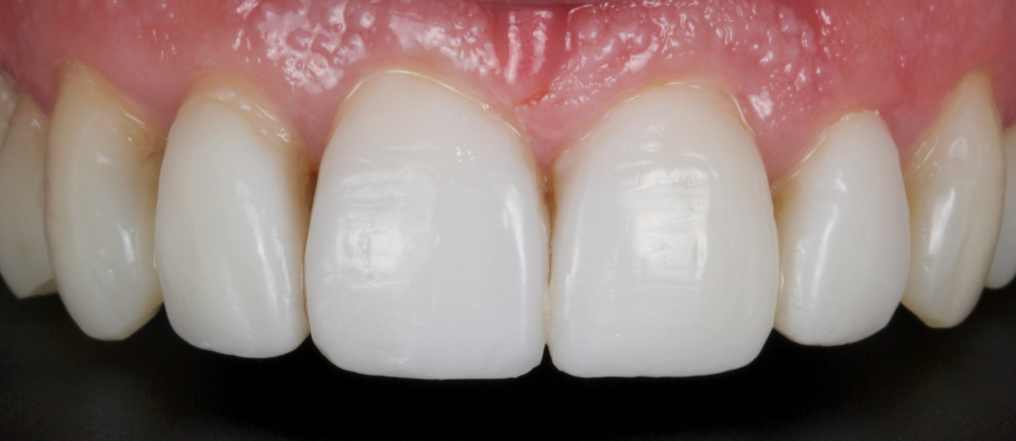 Foundational Treatment Planning for Dental Implants